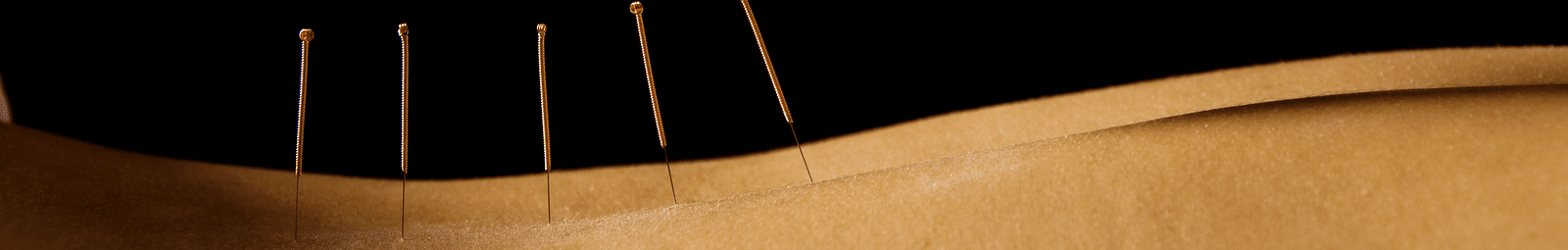 Person receiving acupuncture treatment by physiotherapist