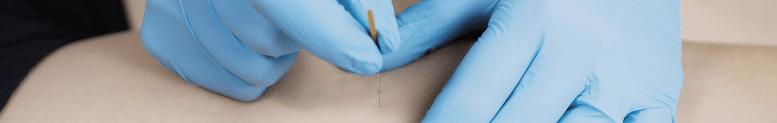 Image of physiotherapist using dry needling technique on patient