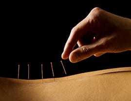 Physiotherapist applying acupuncture to client