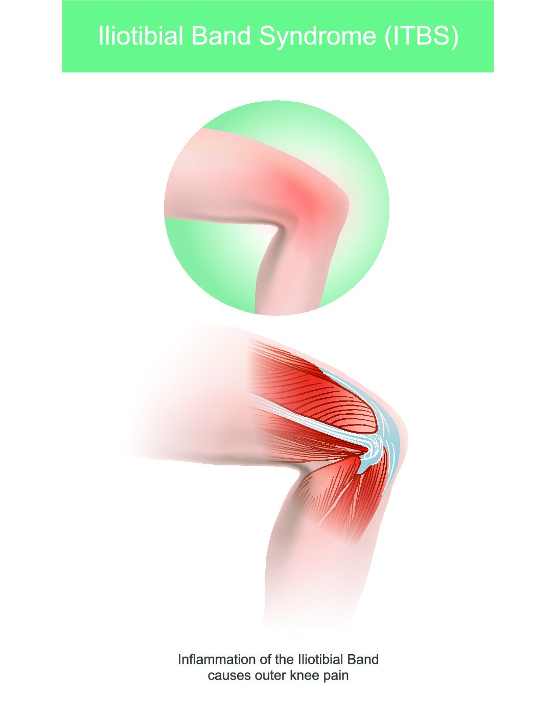 What is Iliotibial band syndrome · Get Better Physio